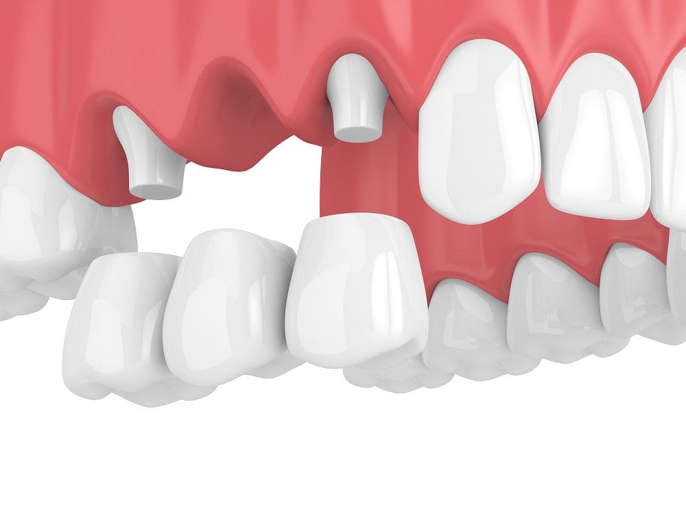 Dental Bridge in Carpentersville, IL