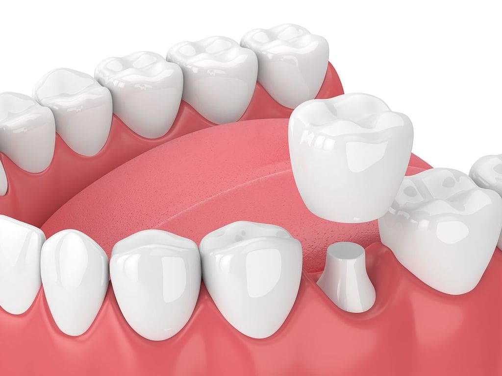 Dental Crown in Carpentersville, IL