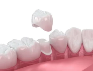 Same-Day Dental Crowns in Carpentersville, IL