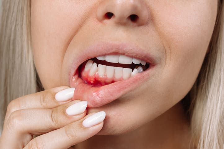 Treatment for Bleeding Gums in Crystal Lake & Carpentersville, IL