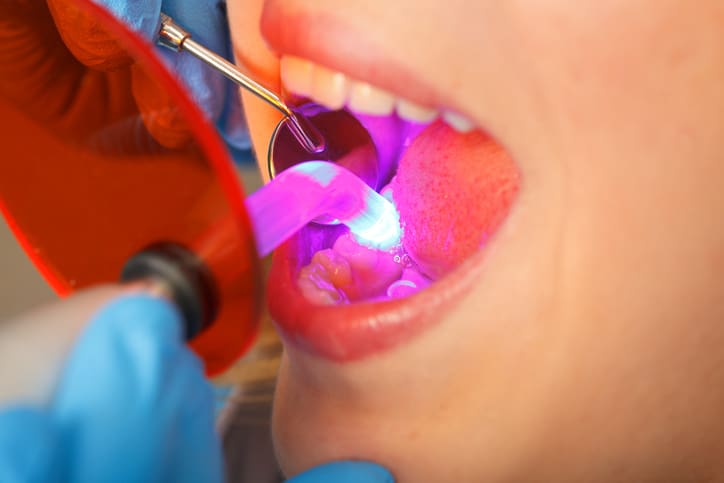 Can Dental Bonding Fix Your Smile? A Guide to What Bonding Can and Can't Do